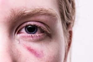 picture of person crying with bruises near eye picture of person crying with bruises near eye